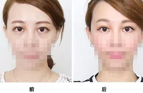 通過手術(shù)祛眼袋多久看都效果?會(huì)有疤痕嗎？