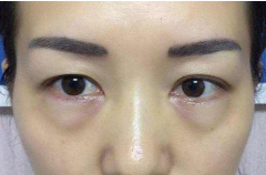 快速去除眼袋后有什么注意事項(xiàng)？