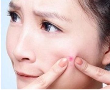 滿臉痘印怎么辦？