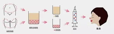 什么，隆鼻方式竟然有這么多種？