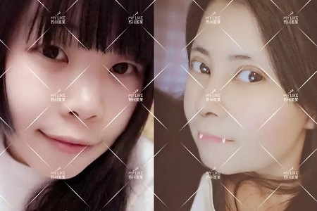 開眼角和不開眼角，差距有多大？