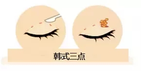雙眼皮我想做埋線，為什么醫(yī)師建議我做全切雙眼皮