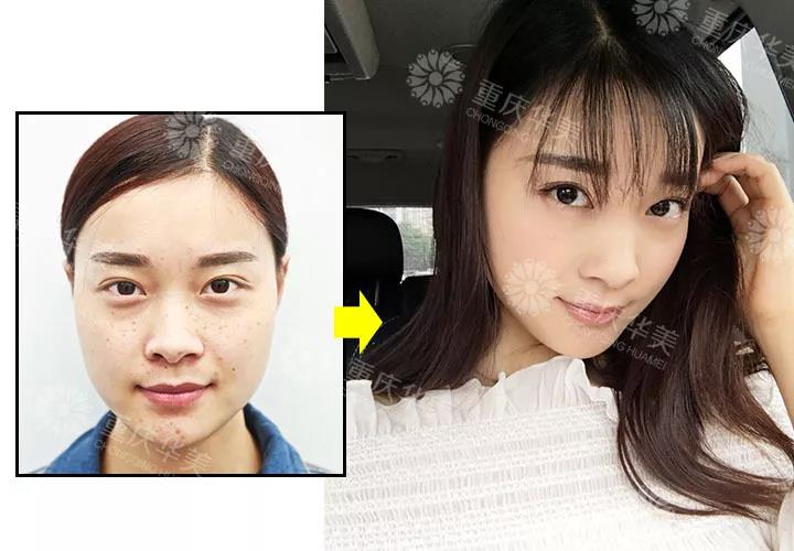 都是用激光打，祛雀斑、黃褐斑、老年斑有啥區(qū)別？