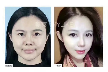 想抗衰，提升和玻尿酸哪個更適合？