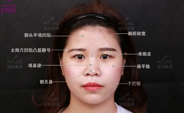 深圳美萊眼神全面改善，整體效果才能大大加分！