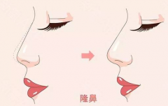 鄭州美萊整形醫(yī)院隆鼻有幾種、效果怎么樣？