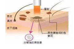 西安整形醫(yī)院做點陣激光多少錢，一次有效果嗎