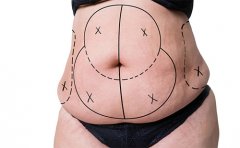 腰腹吸脂對身體有害嗎，腰腹環(huán)吸抽脂需要多久恢復(fù)期