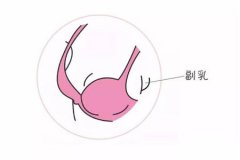 副乳切除術(shù)后需要住院?jiǎn)?，有哪些注意事?xiàng)？