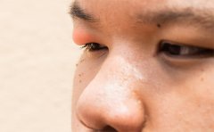 天生腫眼泡抽脂會反彈嗎，南京、杭州、上海眼皮抽脂費用表